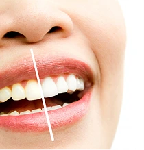 Antes e depois de clareamento dental